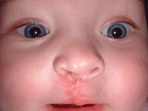 July is National Cleft and Craniofacial Awareness and Prevention Month!
